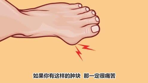 一般这个时候路医生会给大家分析了解拇外翻保守治疗和手术治疗的