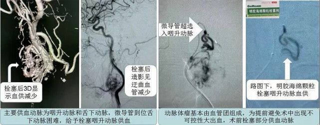 山东省泰安市中心医院卒中中心开展罕见颈动脉体瘤手术成功填补泰安