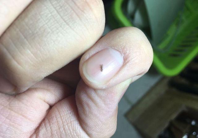 20年前男女老少都有的虱子为何却消失了
