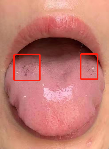 2,如果 舌下两条静脉又黑又粗,说明淤血很严重.