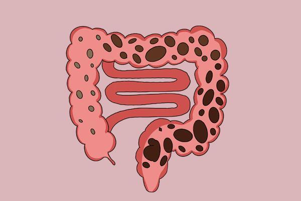 肠道开始病变身体会给出暗示早点留意到及时做肠镜