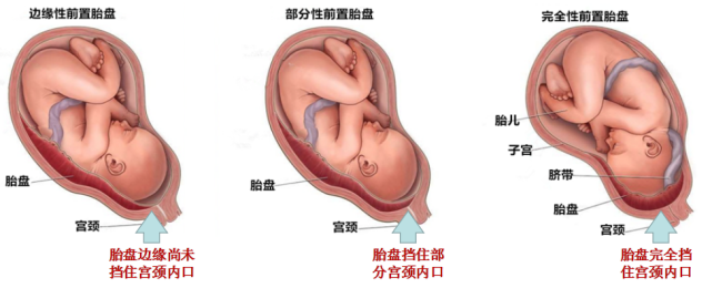 前置胎盘是妊娠28周以后,孕妇的胎盘偏离正常位置,向子宫下段,下缘