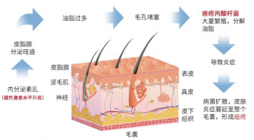 皮脂分泌过多,毛囊皮脂腺导管堵塞,痤疮丙酸杆菌滋生和炎症反应等都是