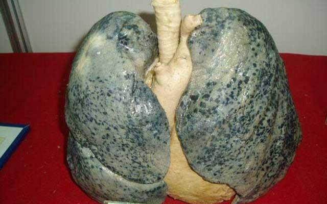 而烟肺之所以会变黑,主要是肺部表面常年被烟焦油所覆盖,越积越厚
