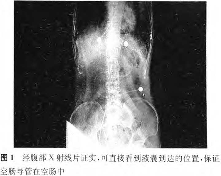 行业了望|液囊空肠导管在重症患者早期肠内营养中的应用