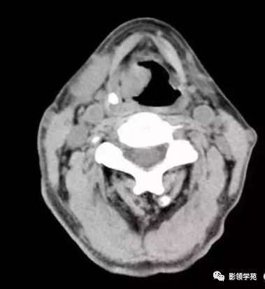 喉癌的影像学诊断