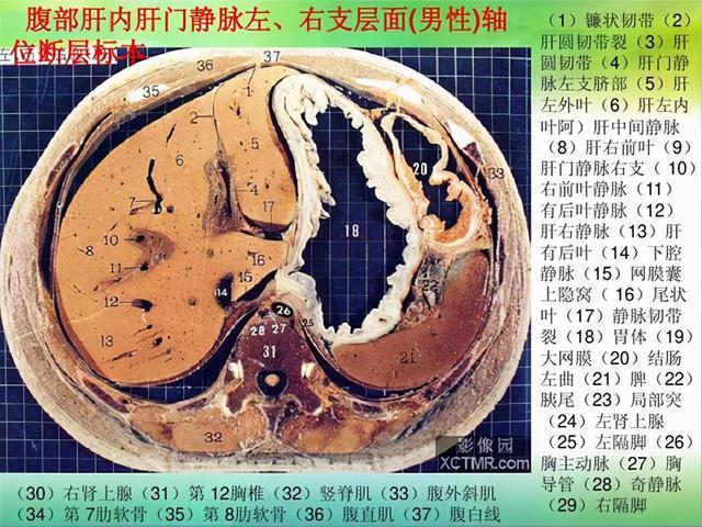 小网膜囊疝临床上多见急性肠梗阻,急症患者需手术,预后一般较好