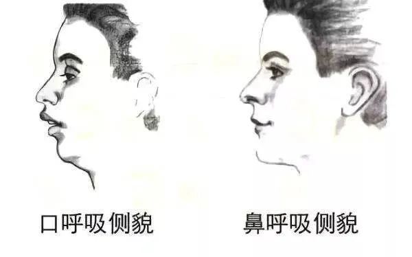 错颌畸形 长期用嘴呼吸,还会影响儿童的容貌.