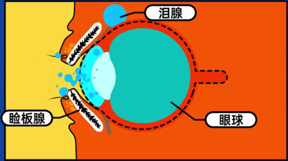 简单来说,睑板腺会分泌油脂形成油膜,保护眼球表面的水膜不被散发