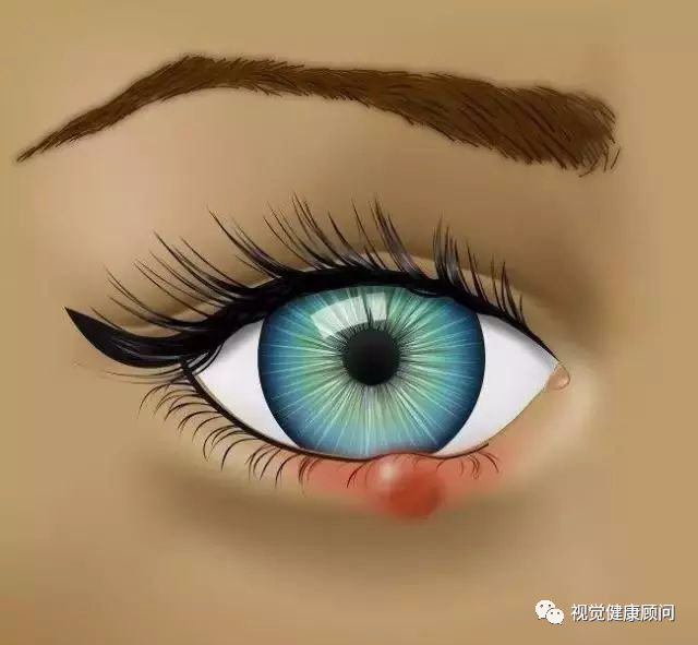1, 麦粒肿