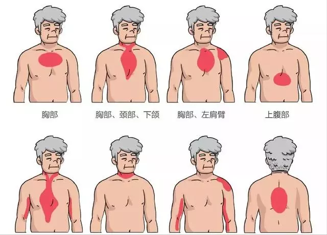 值得收藏急性心肌梗死临床实用知识大全