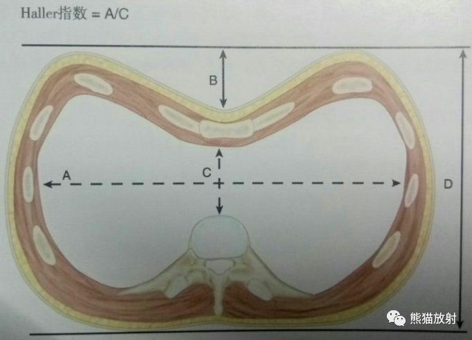 漏斗胸(4)鸡胸:与漏斗胸相反,胸骨的上部及其肋软骨向前突出,胸部左右