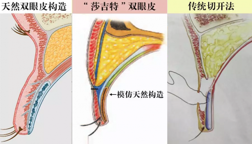 实例分享修志夫莎吉特双眼皮做完能有多美