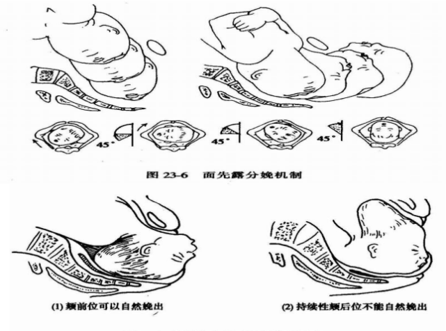 2,诊断1)腹部检查:因胎头极度仰伸入盆受阻,胎体伸直,宫底位置较高.