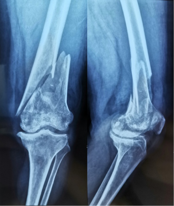 行x线示:左膝关节面不规则,符合大骨节病性关节炎表现.