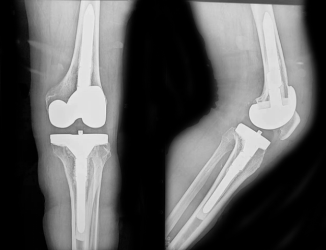 后患者出现左侧膝关节疼痛,逐渐加重,以至于不能行走,x线检查示置换