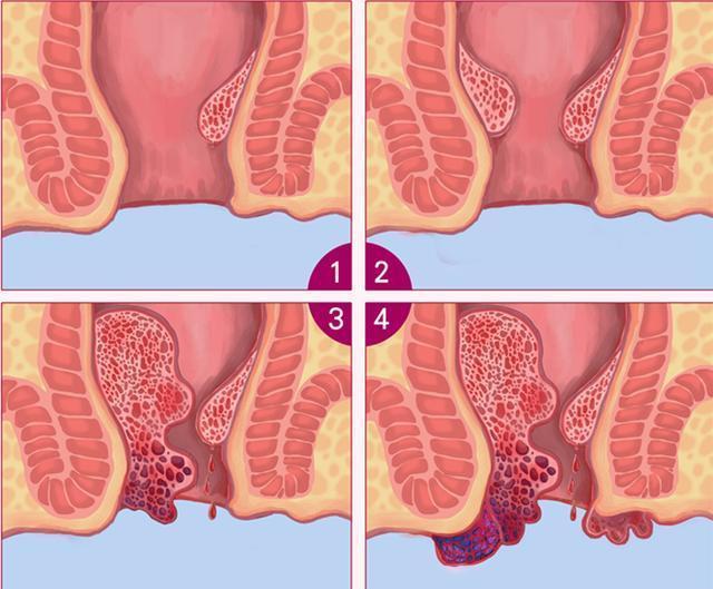 关于痔疮手术的5个疑问,看看有没有你想知道的?