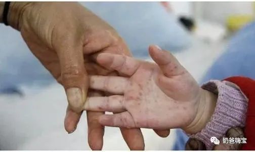 手足口病是由多种人肠道病毒引起的一种儿童常见传染病.