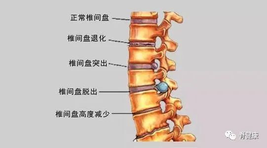 2,退行性椎间盘病·腿痛无明确的概念,常常难以表达,主诉为臀部或下肢