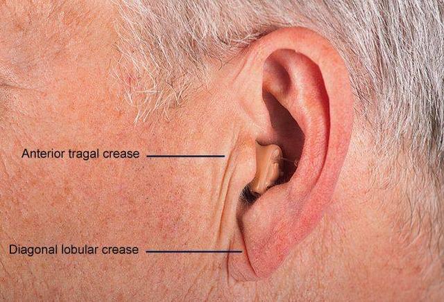 最近,耳垂褶皱也表明可能患有脑血管疾病.耳朵上有褶皱五个身体表现