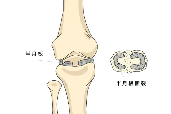 运动时身上的3个表现或说明你半月板受损了该如何预防