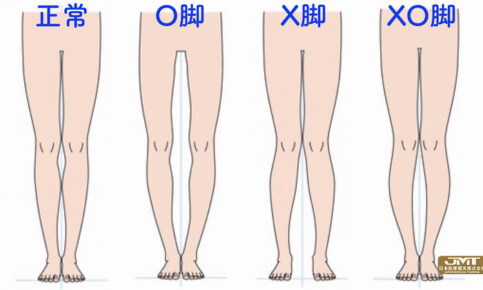 jmt日本医疗孩子的o型腿和x型腿有时需要治疗和观察