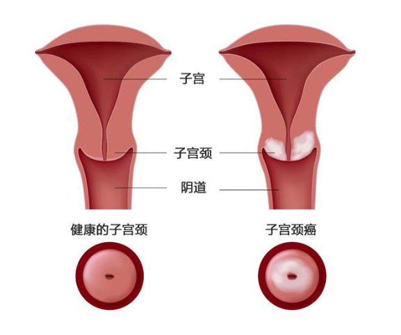 宫颈癌来来临脸先知医生宫颈癌变的人脸上常有3个特征