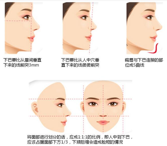 就个人经验来说,下颏的完美还是建议以假体隆颏为首选.