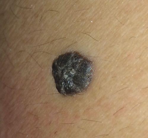 表面不平的痣正常的痣都是比较平整的,但是如果发现身上的痣出现了