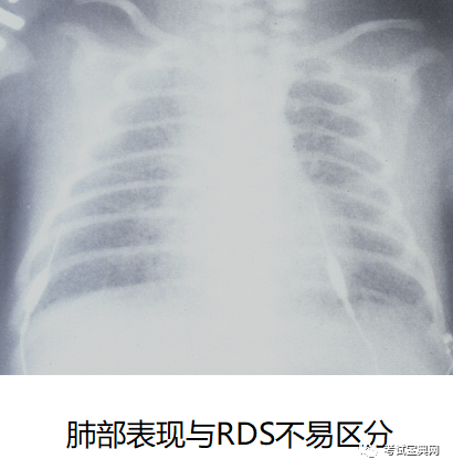rds的最佳手段,可见三大典型表现 (1)毛玻璃样改变 (2)支气管充气征