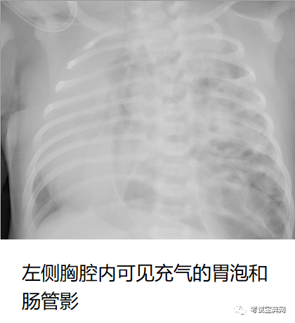 rds的最佳手段,可见三大典型表现 (1)毛玻璃样改变 (2)支气管充气征