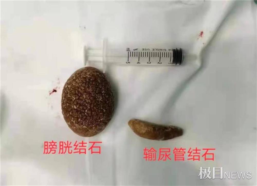 中年男每天喝啤酒想化掉膀胱结石谁知小石头长成大鹅蛋