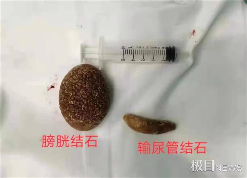 中年男每天喝啤酒想化掉膀胱结石,谁知小石头长成