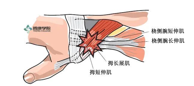 交叉综合征是一种以拇长展肌和拇短伸肌以及桡侧腕长伸肌腱,桡侧伸腕