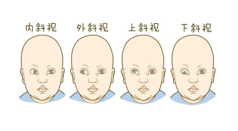 苏州5岁女孩看东西出现双影原来是内斜视惹的祸