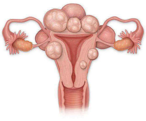 贝安健康:子宫肌瘤和卵巢囊肿有什么区别?