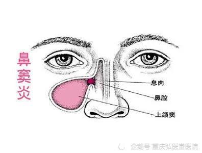 什么叫副鼻窦炎 腾讯网