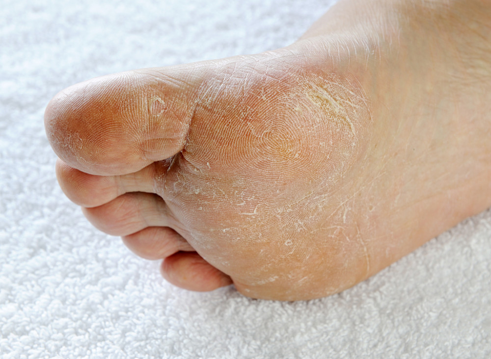 脚气病的症状有哪些?哪些原因会导致脚气?如何预防脚气病?