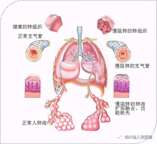 长期咳嗽咯痰却放任不管,小心得慢阻肺
