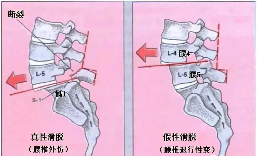 二,什么是腰椎滑脱 腰椎滑脱是指由于关节突间连续性中断或延长引起