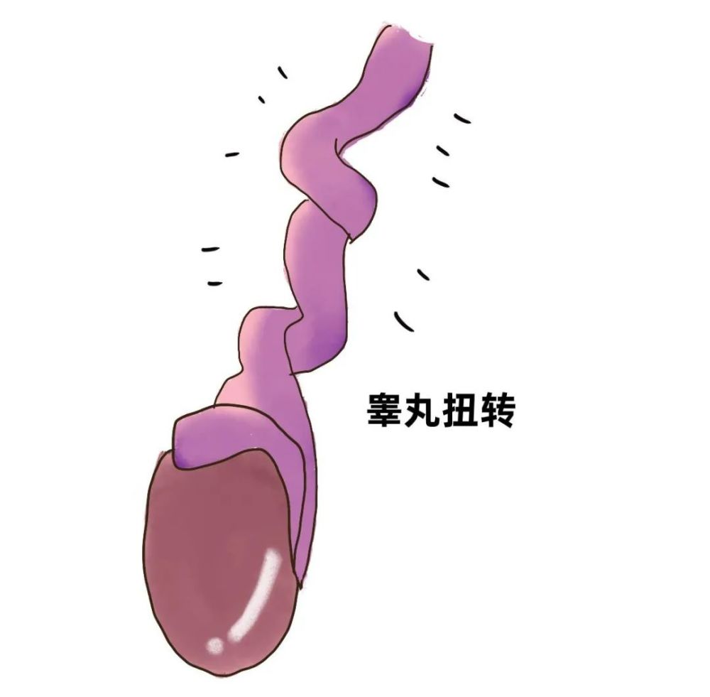 手术团队紧急手术 术中切开患者阴囊后 发现其睾丸,附睾呈暗黑色 肿胀