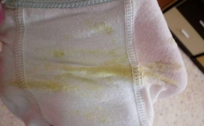 感染hpv后,最显著的特征就是私处的尖锐湿疣,往往会成菜花状.