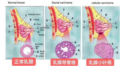 人群特征流行病学 研究:这些是乳腺癌的危险源