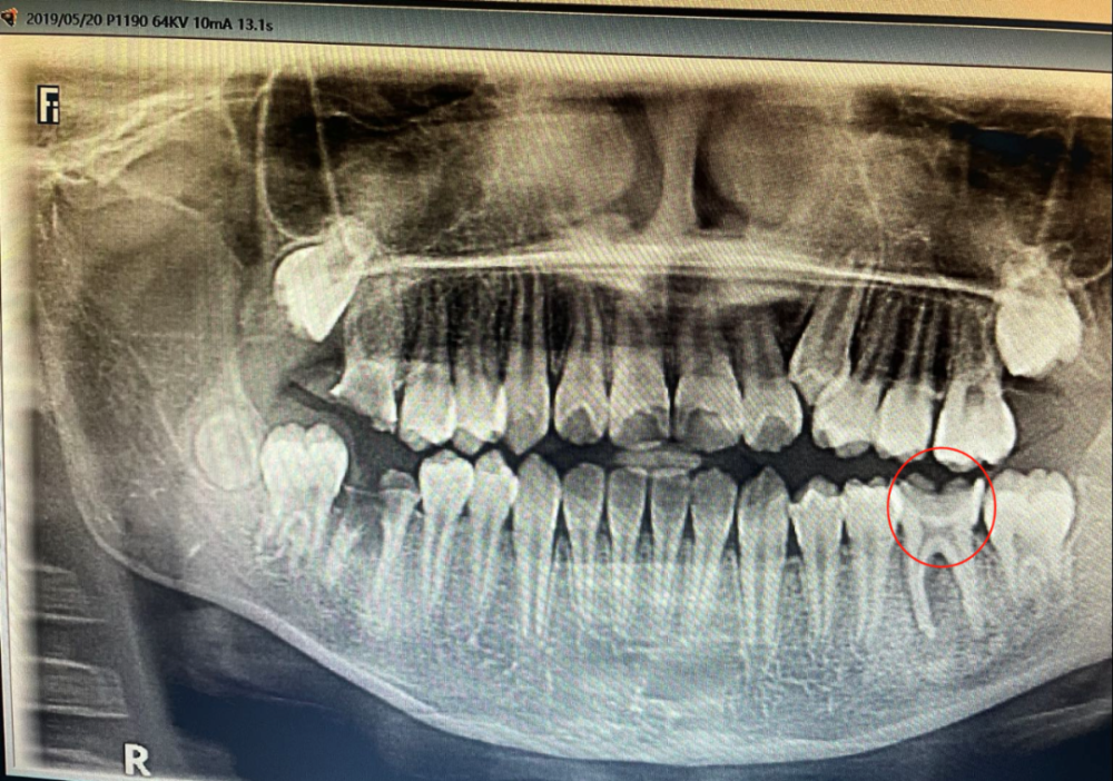 第一次入院治疗时,壮壮的左下"六龄齿"状况尚可,无需拔牙