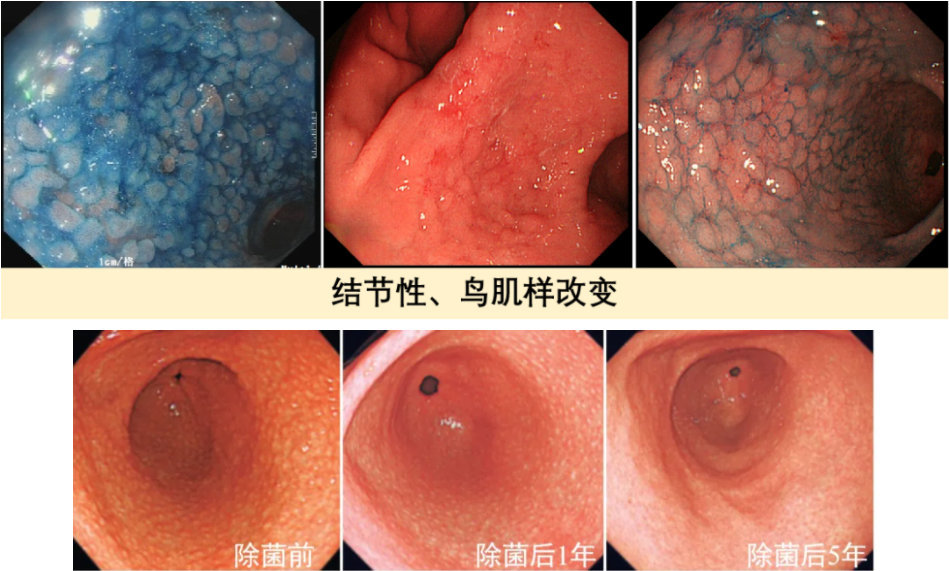 角及胃窦部;研究发现鸡皮样胃炎是初次感染hp导致的过度免疫应答所致