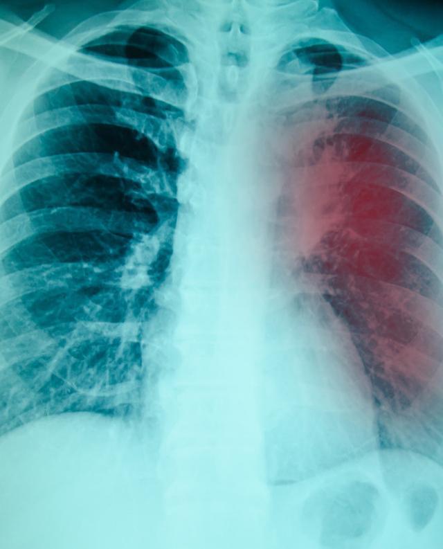 肺部ct能查出肺结核吗?出现3种情况就别拖了