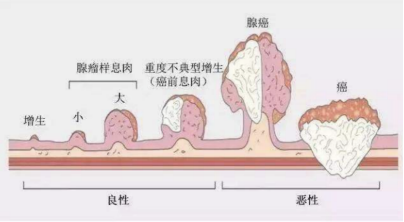 首都医科大学附属北京中医医院屈凡凡医师:肠道息肉知多少?