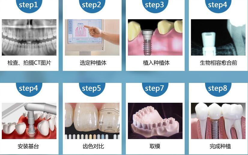 医生之后做的工作就是安装和调整,而种植牙需要做不少检查,然后要在