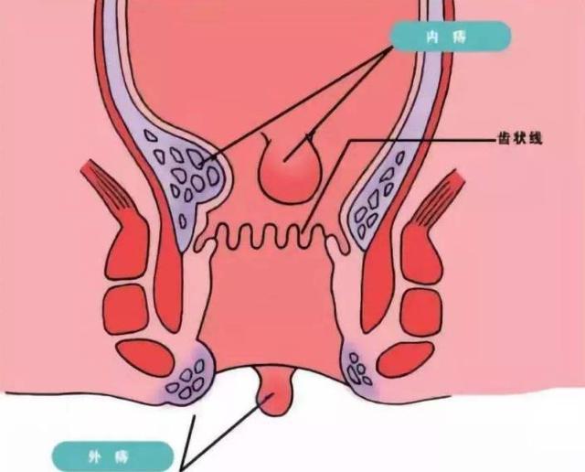 肛门附近长出"小肉球",别只以为是痔疮,也可能是这2种