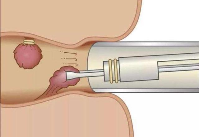 肛门附近长出小肉球别只以为是痔疮也可能是这2种疾病